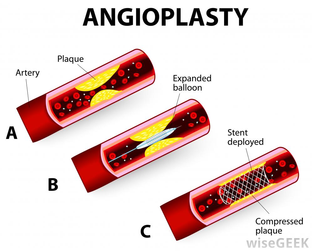 什么是颈动脉血管成形术(Carotid Angioplasty)？图2