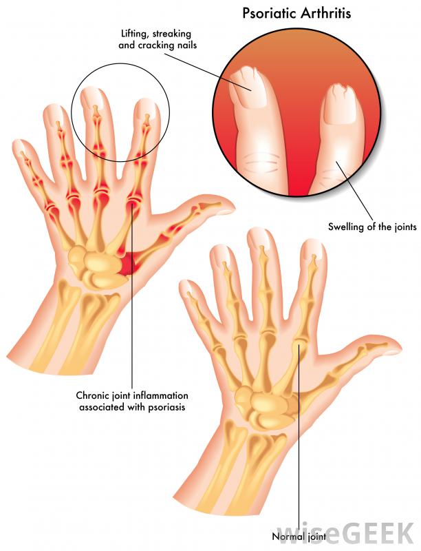 用死海的盐治牛皮癣有效吗(Is It Effective to Use Salt from the Dead Sea for Psoriasis)？图1