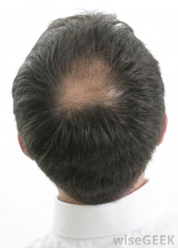 如何选择最好的脱发乳液(Choose the Best Hair Loss Lotion)？图1