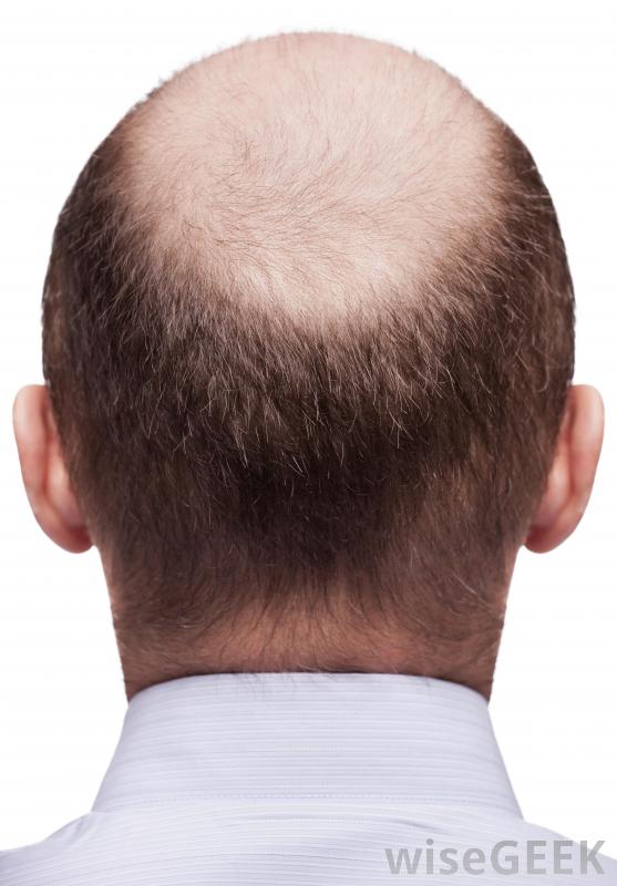 我如何选择最好的头发稀疏洗发水(Choose the Best Shampoo for Thinning Hair)？图2