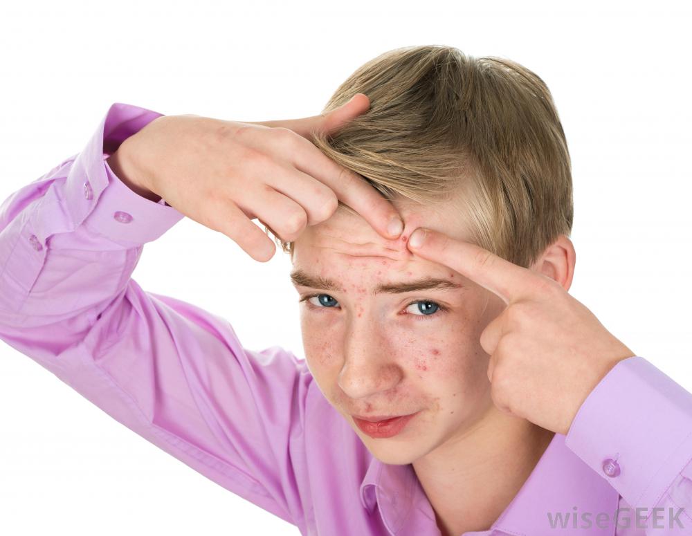 如何减少痤疮引起的色素沉着(Reduce Hyperpigmentation from Acne)？图1