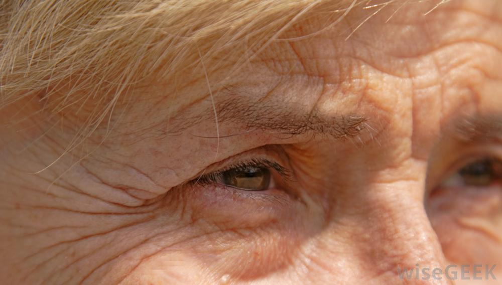 什么是眼睑紧绷(Eyelid Tightening)？